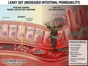 Anatomical diagram of the intestinal wall showing the difference between healthy tight junctions and leaky gut collapse with toxins entering the bloodstream.