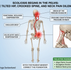 Medical infographic of functional scoliosis: Showing how a tilted pelvis leads to a curved spine, dropped shoulder, and chronic neck pain, corrected by Master Shahid Khan at Yogveda Yoga Switzerland.