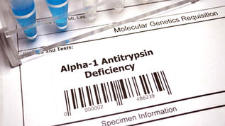 Alpha-1 Antitrypsin Deficiency