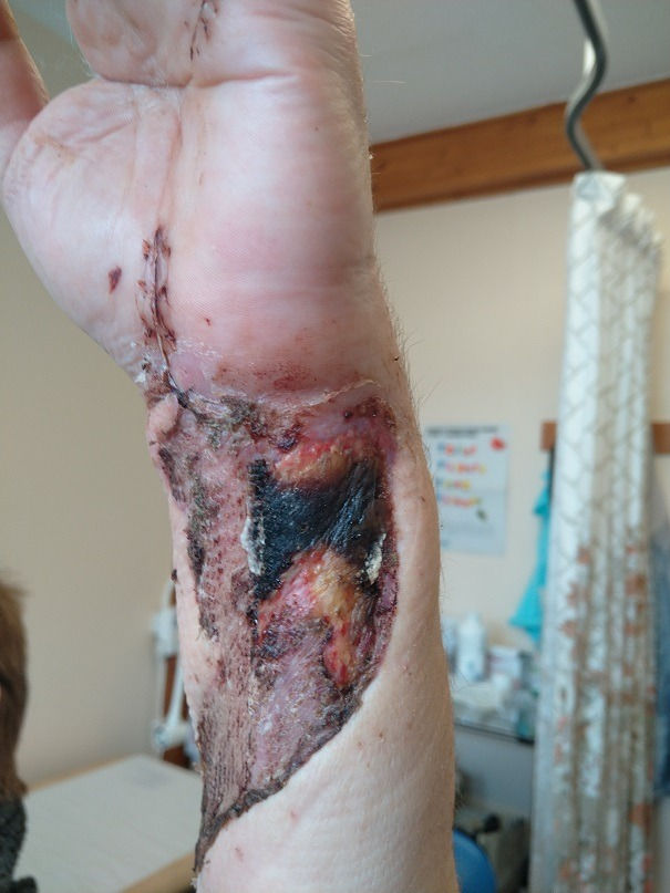 My injury exactly 1 month after the accident in Saltcoats GP practice
