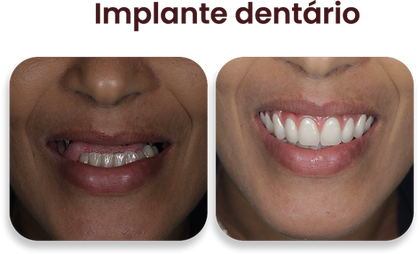 Implante dentário
