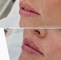 before and after photo lip filler chelmsford essex.jpg