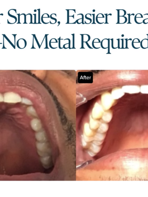 The Natural Expander Within: How Releasing Palate Tension Changes Everything