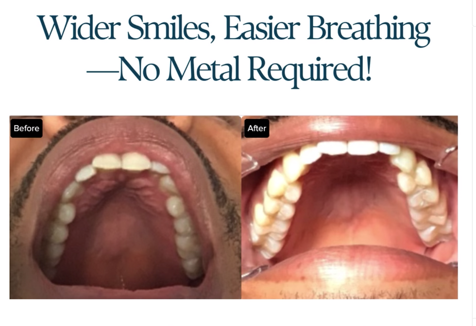 The Natural Expander Within: How Releasing Palate Tension Changes Everything