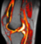 Knee_MRI