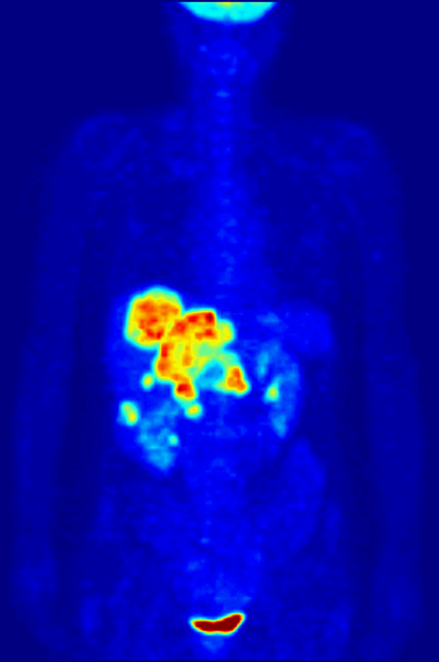 PET Scan GIF.gif