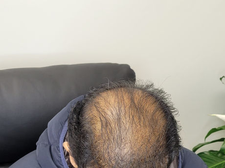 Is Vitamin D Deficiency Behind Your Hair Loss?