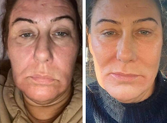 prp fat tranfer before and after.png