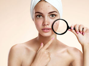Seven tips for acne treatment success: 