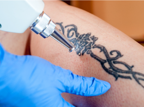 Tattoo regret is not uncommon.