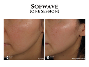 The Science of Refreshing Your Radiance: Inside Our Latest Sofwave™ Transformation