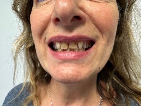 Trattamento di estetica dentale per ritrovare un sorriso naturale