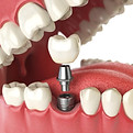 implantologia dentale all'estero