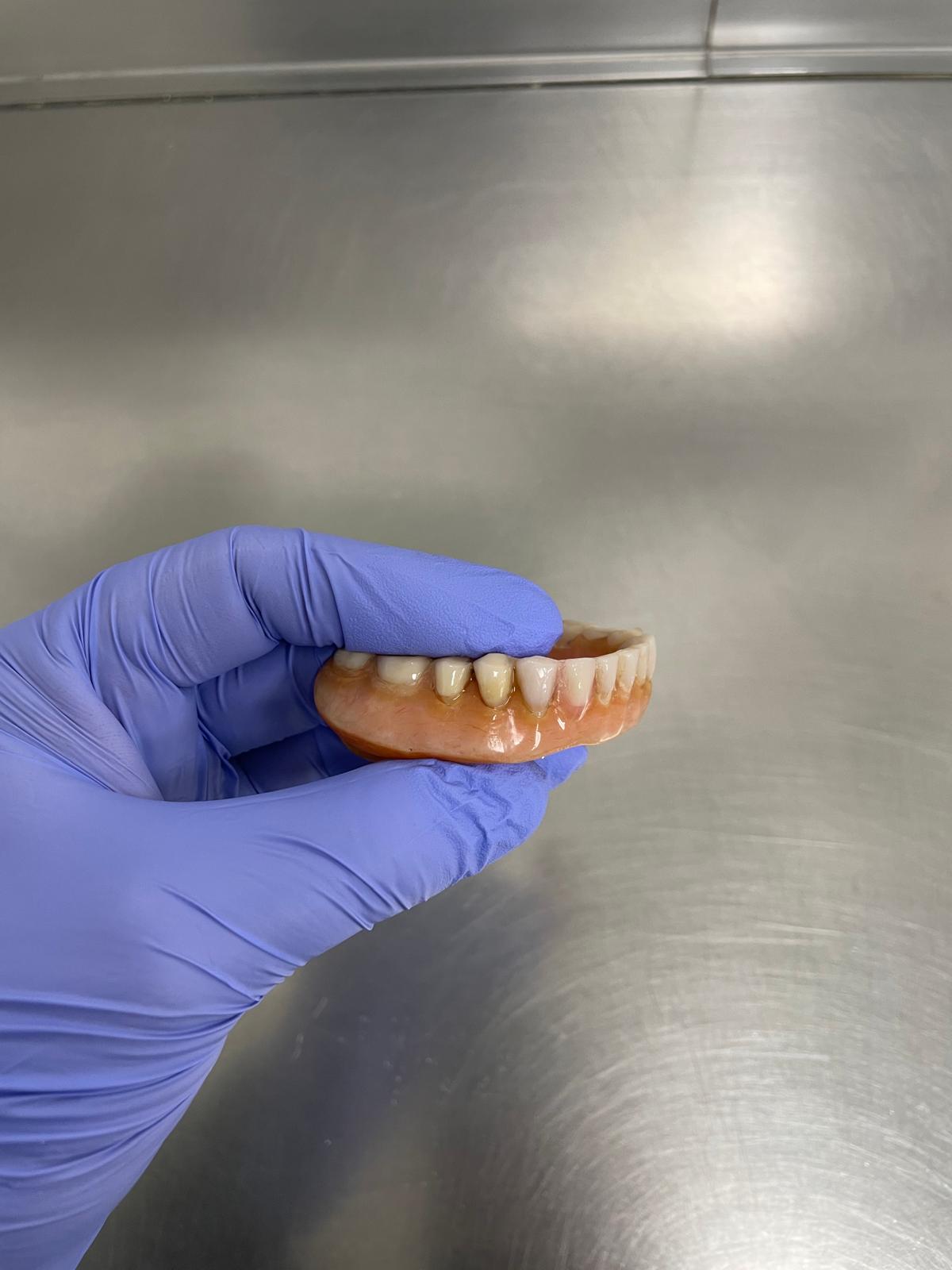 Denture before professional cleaning