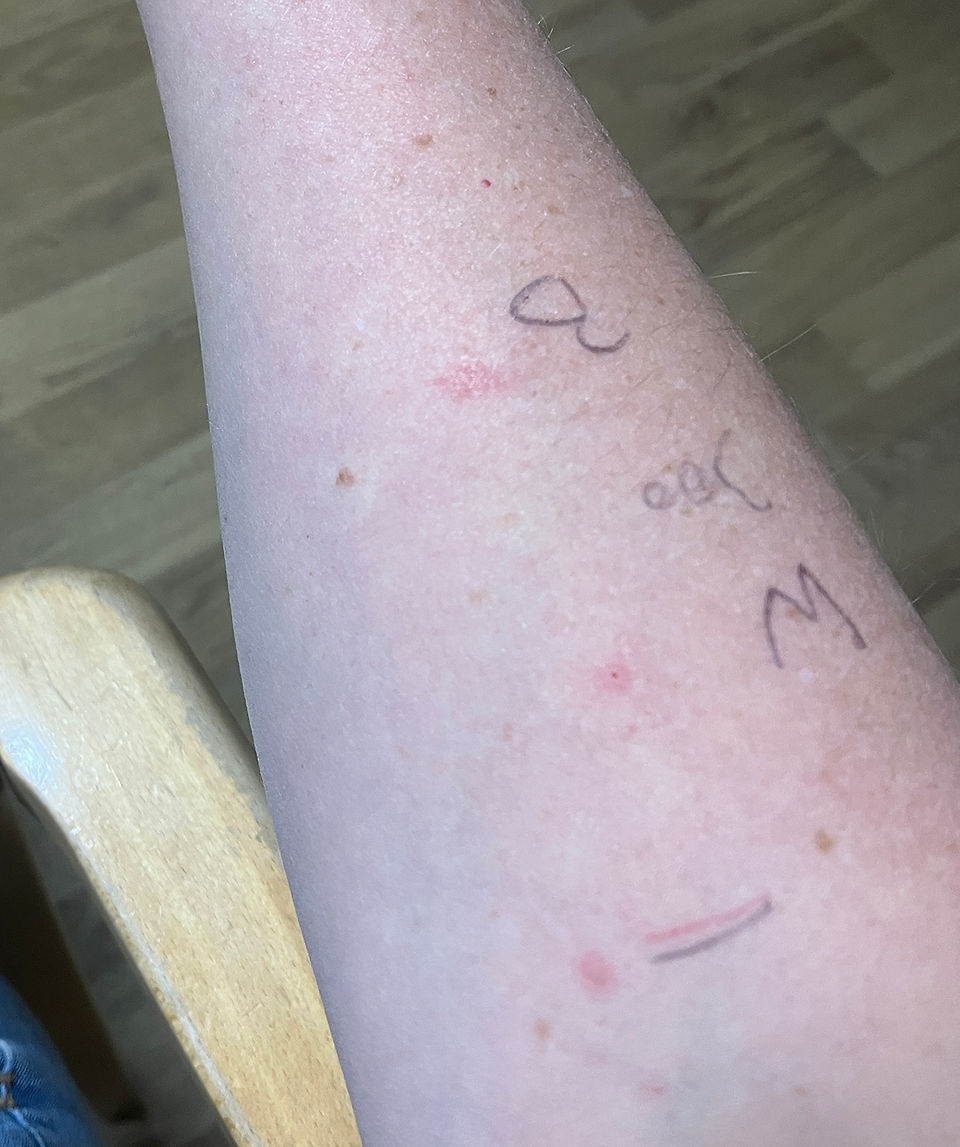 wasp and bee sting areas on a forearms during an allergy testing appointment