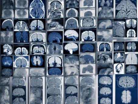 Unlocking the Secrets of the Brain: Neuroimaging Case Studies