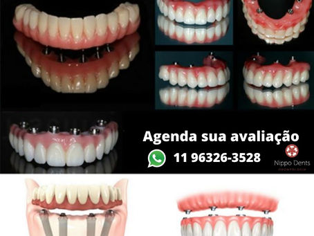 IMPLANTE DENTÁRIO E PRÓTESE FIXA