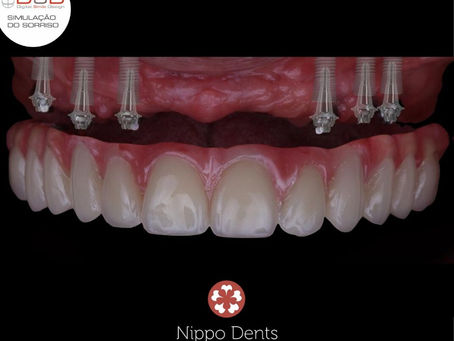 OS 05 MAIORES BENEFÍCIOS DO IMPLANTE DENTÁRIO 😲😲😲
