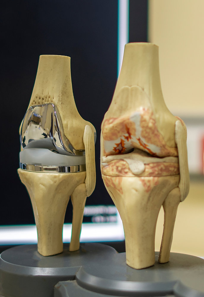 How successful is a Knee Replacement Surgery?