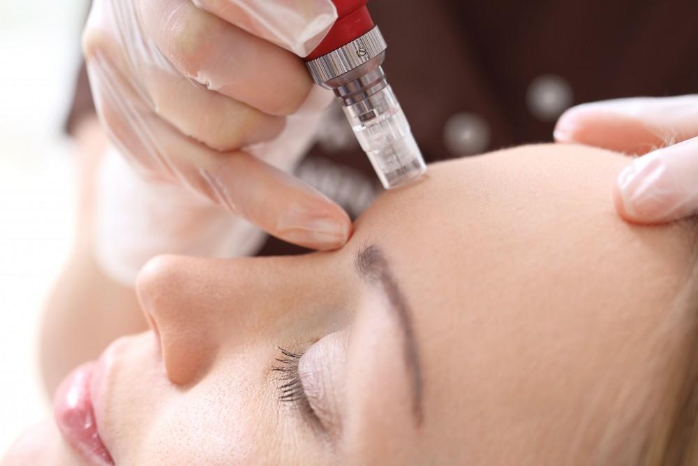 Facial Micro Needling