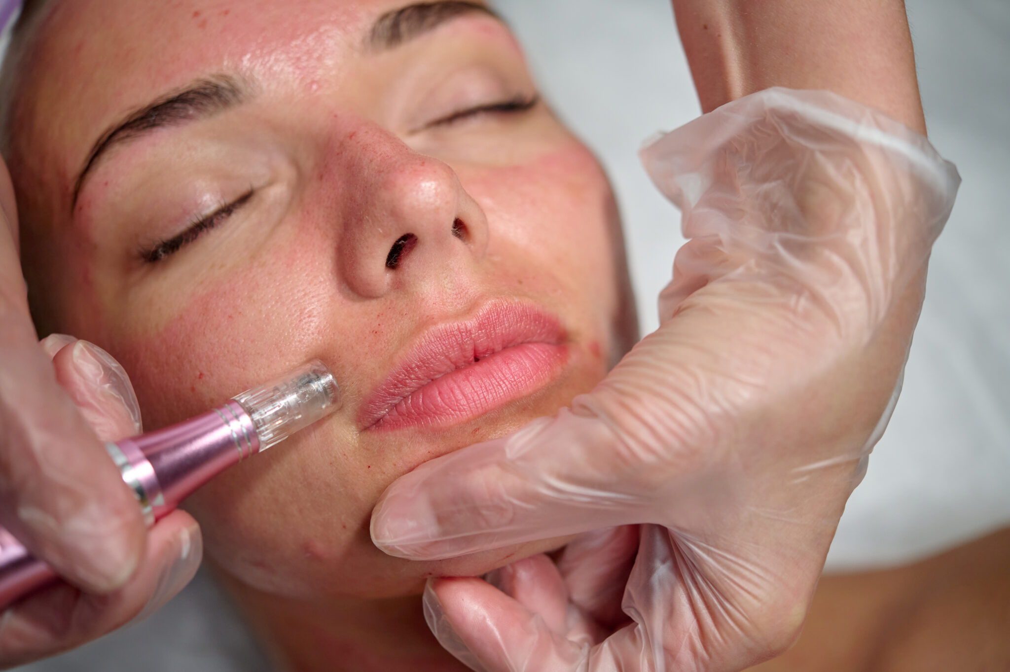 Facial Micro Needling Full Face & Neck