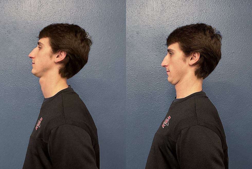 Chin Tuck Tech Neck Stretch Demonstration