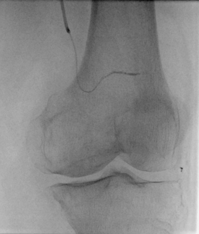 Embolisation du genou - micro cathétérisme