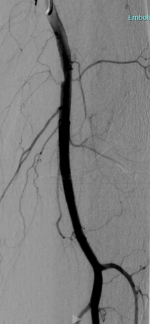 Embolisation du genou - fin