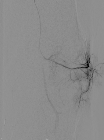 Embolisation du genou - hypervasculkarisation synoviale