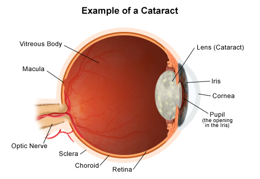 Cataracts