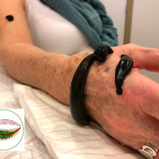 rhizartrose, duimartrose, gebruik van hirudo medicinalis