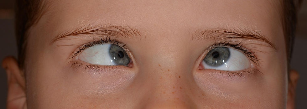 Childhood Squint: Understanding When a Child’s Eyes Don’t Look Straight