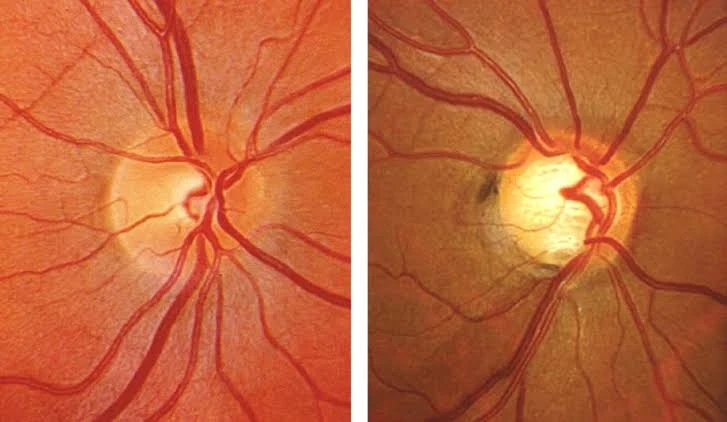 glaucoma, fundus