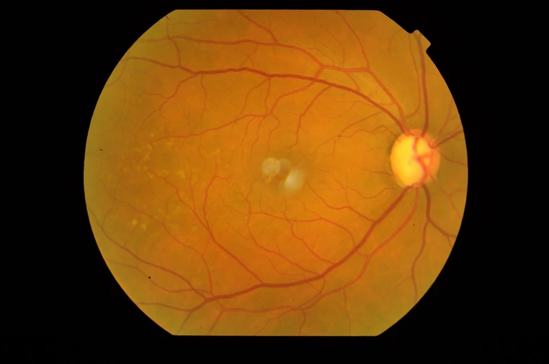 optic disc