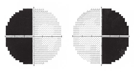 neurophthalmology, perimetry, visual field defects