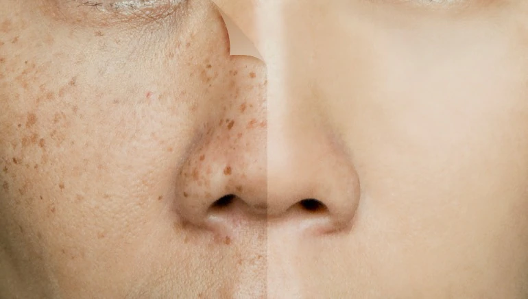 skin-pigmentation (1).webp