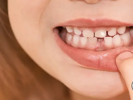 Why Does My Child Have White Spots on Their Teeth? Common Causes and Treatments
