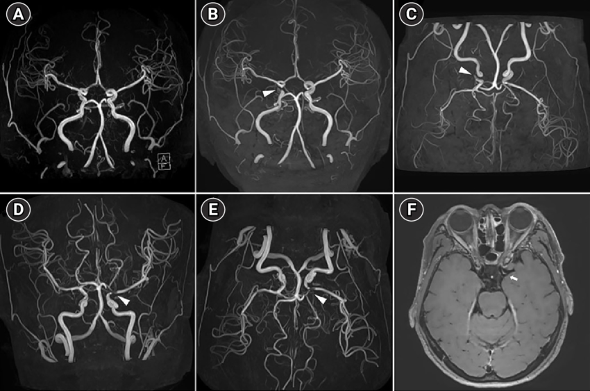 Brain-magnetic-resonance-angiography-MRA-and-high-resolution-magnetic-resonance-imaging.pn