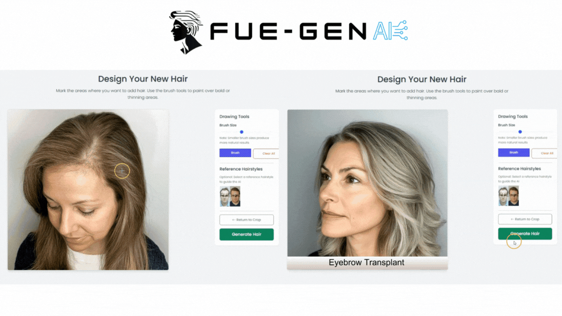 HAIR TRANSPLANT AI RESULT GENERATOR: TRANSFORMING CONSULTATIONS WITH PRECISION VISUALIZATION