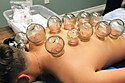 Daravida Family Chiropractic and Wellness Cupping Therapy Pain Relief Amarillo TX.JPG