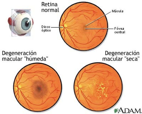 DMRE-Clarity-oftalmologos-ojos-vision-glaucoma-retina-oftalmologia