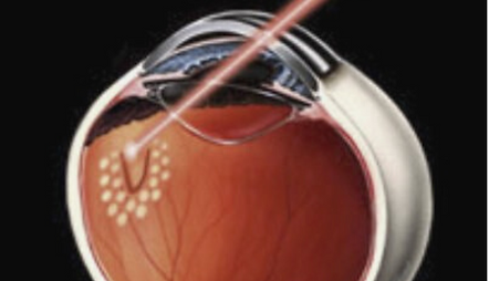 Copia de lasers Madeleine SM (Presentación (169)) (1).png