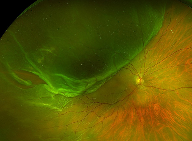 desprendimiento-de-retina-Clarity-oftalmologos-ojos-vision-glaucoma-retina-oftalmologia