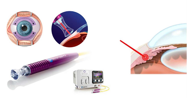 Oftalmología, oftalmólogo, oftalmóloga, centro de ojos, roca, general roca, glaucoma, presión ocular, ojo seco, nervio óptico