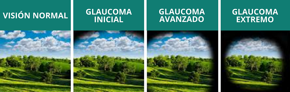 Oftalmología, oftalmólogo, oftalmóloga, centro de ojos, roca, general roca, glaucoma, presión ocular, ojo seco, nervio óptico