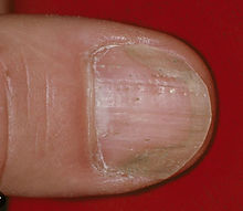 nail psoriasis