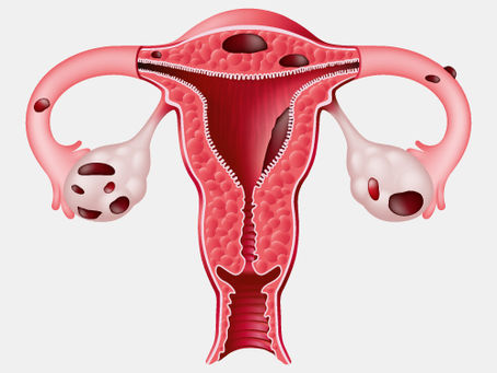Illustrazione anatomica dell’endometriosi con tessuto uterino fuori dall’utero