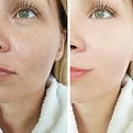 vampire facelift