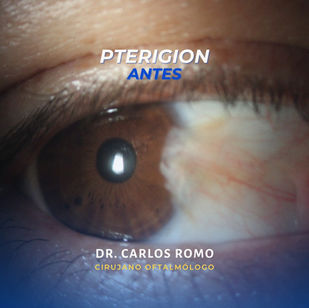 Caso real de paciente: PTERIGION antes y después
