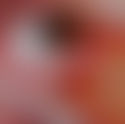 Paciente con retinopatía diabética tratada con láser por el Dr. Carlos Romo en Clínica COVA.